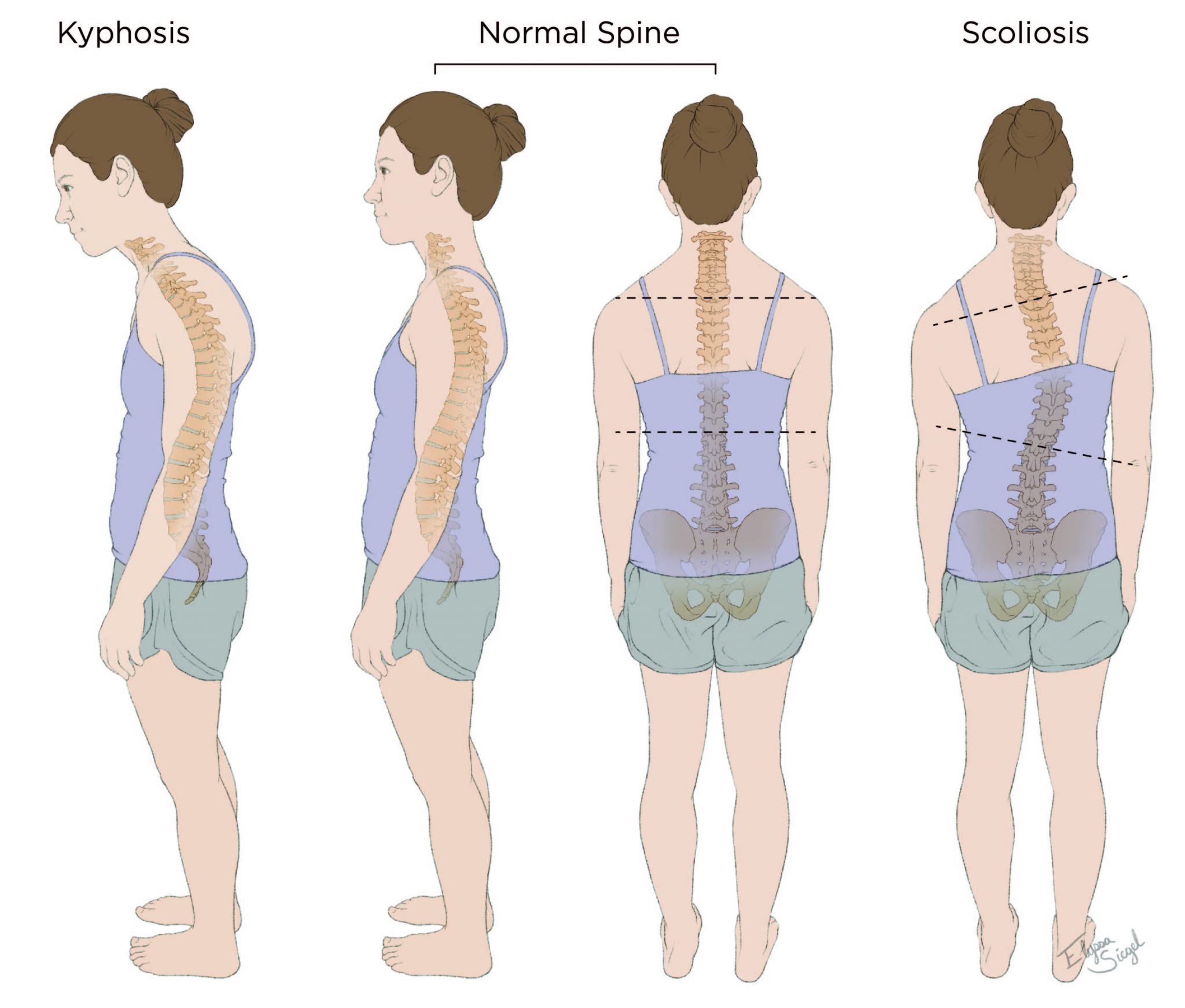 Scoliosis And Kyphosis Scoliosis XOTZA