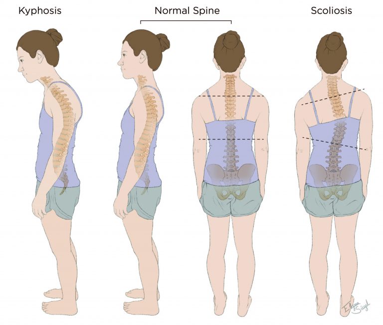 Kyphosis/Scoliosis Goodman Campbell