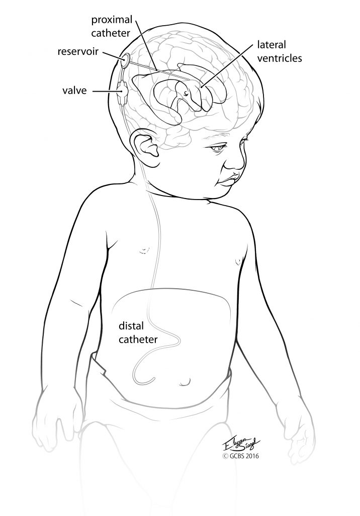 Ventriculoperitoneal Shunt Placement for Hydrocephalus in Adults - What You  Need to Know