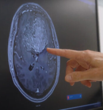 Neurosurgeon pointing to brain tumor on MRI.