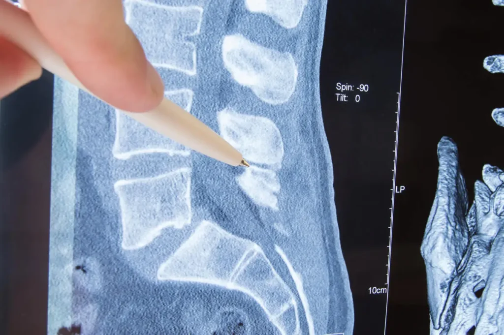 A Guide To Foraminotomy For Spinal Stenosis