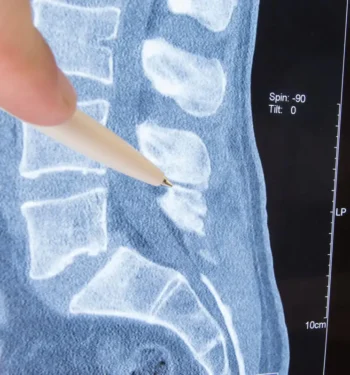 A Guide To Foraminotomy For Spinal Stenosis