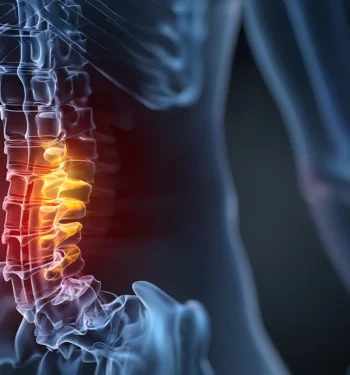 Neurogenic Claudication From Spinal Stenosis_